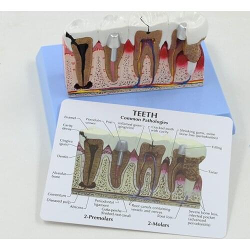 Anatomy Human Teeth Common Molar Pulp Gingival Root Pathological Model