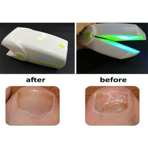 NEW Home Use Toe Nail Fungus low level cold Laser Therapy Device Onychomycosis Treatment Anti Fungal LLLT
