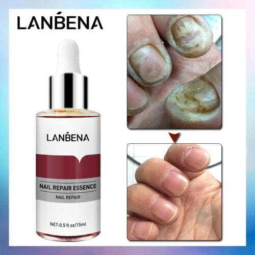 Nail Fungal Treatment Essence Foot Toe Nail Fungus Removal Gel Anti Infection Paronychia Onychomycosis Nail Repair