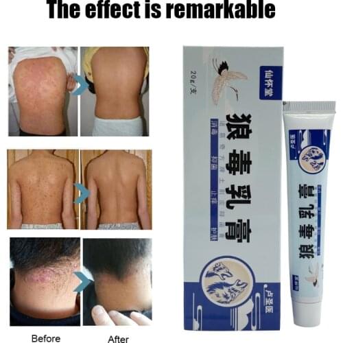 Treatment Psoriasis Cream Skin Care Antibacterial Antipruritic Dermatitis Eczema Herbal Ointment Anti-Itch Medical Plaste