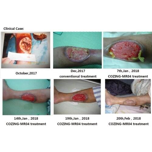 Wound healing professional PDT led machine/ photo facial machine/led red light therapy machine for skin