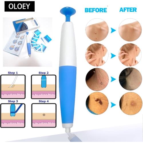 1kit Tag Remover Kits Face Auto Band Skin Care Beauty Tools Wart Remove Acne Pimple Blemish Treatments With 10pcs Rubber bands