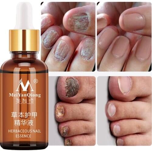 Feet Care Essence Nail Fungal Treatment Nail Foot Whitening Toenail Fungus Removal Gel Anti Infection Paronychia Onychomycosis