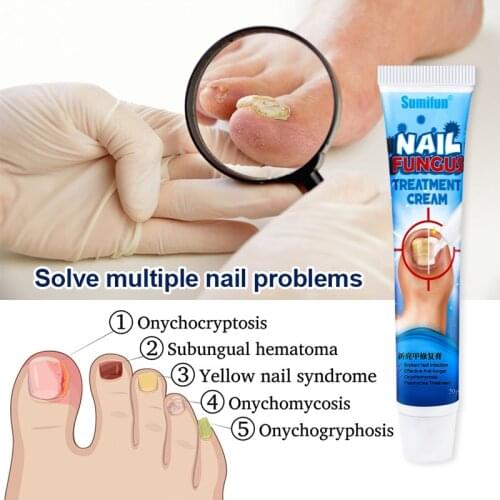 1pc Nail Fungus Removal Cream Onychomycosis Fungal Nail Treatment Paronychia Anti Infection Feet Toe Fungal Nail Repair Ointment