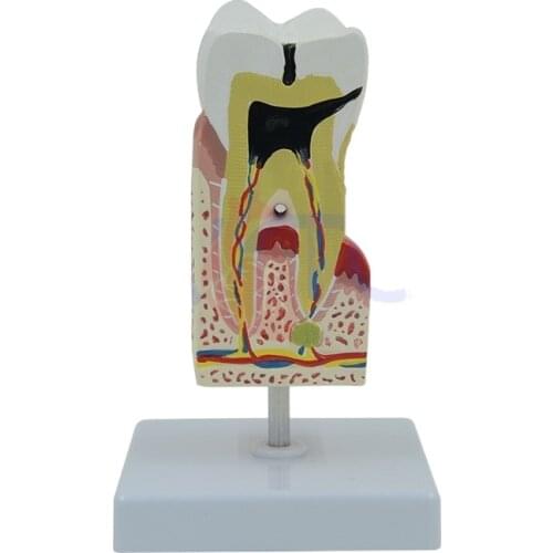 Enlarged Human Teeth Care Model Tooth Decay Dental Caries Medical Student Medical Supplies Teaching Resources Anatomical Model