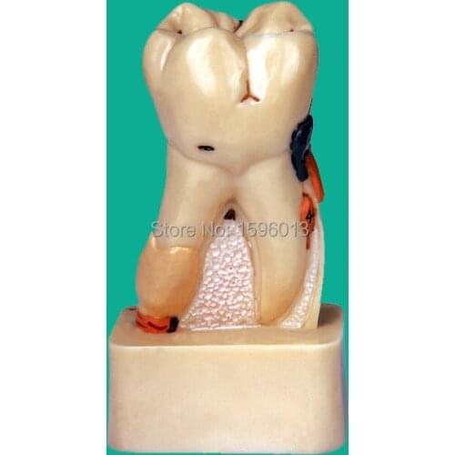 Dissected Model of Dental Disease, dental disease pathology decomposition model