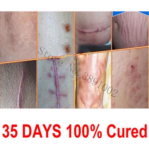 100% Natural Authentic Anti Acne Spots Essence Oil Scar Removal Remove Cream for Belly Stretch Mark Skin Whitening Moisturizing