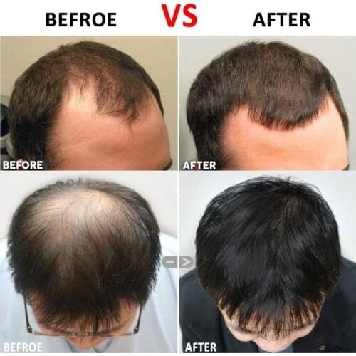 Hair Regrowth Micro-needling Roller Beard Growth Product Anti Hair Loss