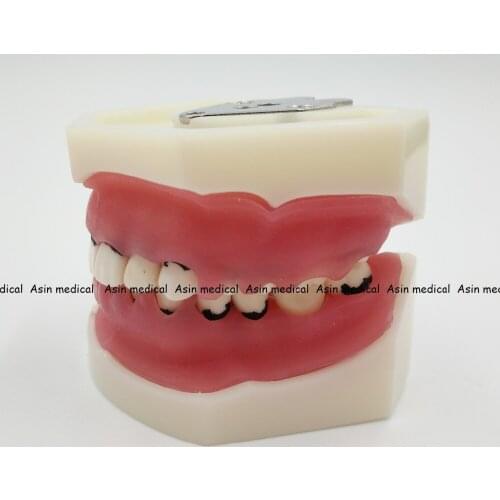 High Quality Dental Periodontal Disease Model / Tooth Medical Model