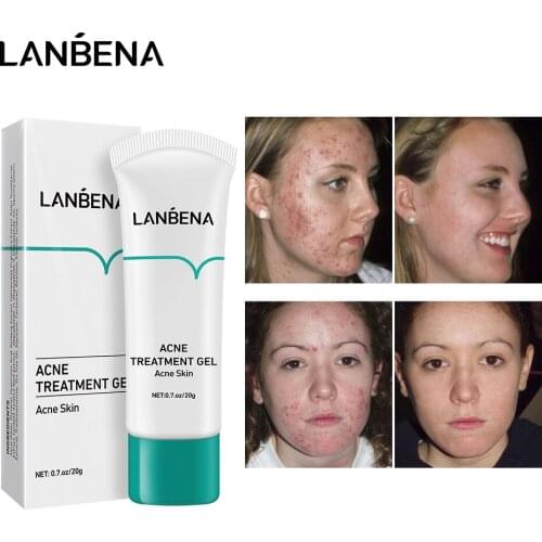 LANBENA Removal Acne Blackheads Pimples Gel Moisturizing Face Cleansing Cream Gentle Anti-inflammatory Oil Control Facial Care