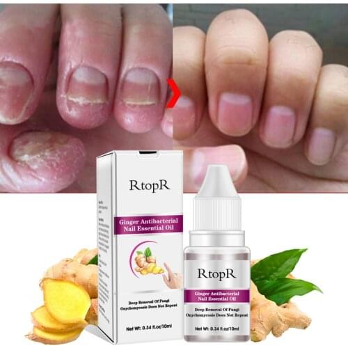RtopR Nail Treatment Feet Care Essence Nail Foot Whitening Toe Nail Fungus Removal Gel Anti Infection Paronychia Onychomycosis