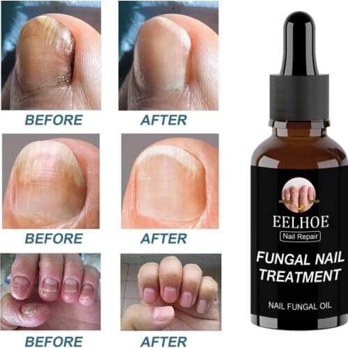 Fungal Nail Repair Serum Repair Care Foot Nail Fungus Removal Gel Anti Paronychia Onychomycosis 10ml/20/30/50ml Woloesale TSLM2
