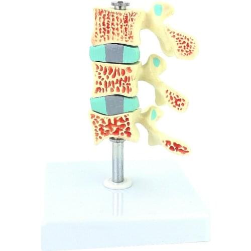Human osteoporosis model osteoporosis model human intervertebral disc lumbar model orthopedic pain department