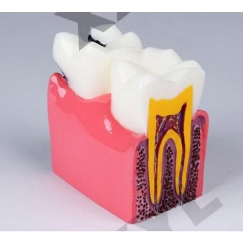Patient communication monomer Dissection enlarge model 6X Caries Compare Models free shipping