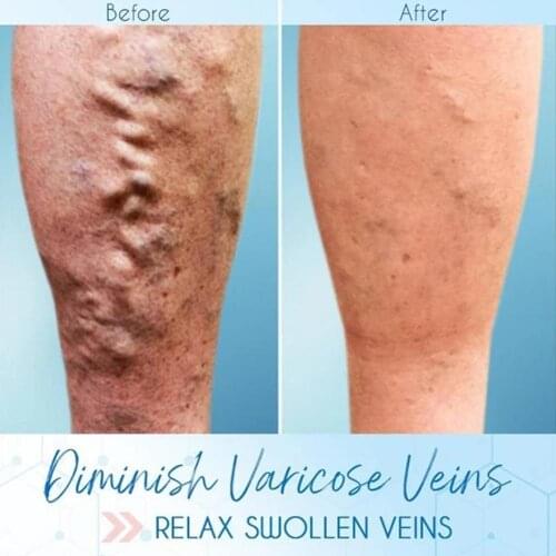 Heath Blue Light Therapy Varicose Veins Treatment Pen Soft Scar Removal Massage Treatment and Pen Cream Acne Y0D1