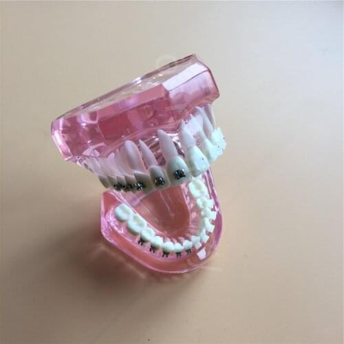 Dental Orthodontic Model with Metal and Ceramic 3003 Pink Brackets Dental Teeth Study