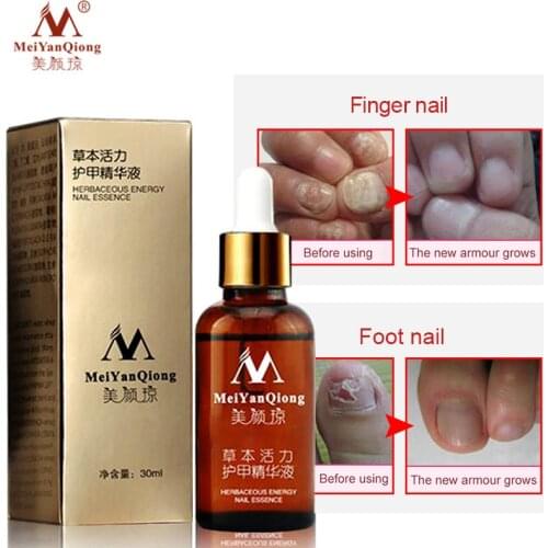 Herbaceous Energy Nail Essence Remedy For Nail Fungus Treatment Feet Care Essence Whitening Toe From Nail Remove Gel Antifungal