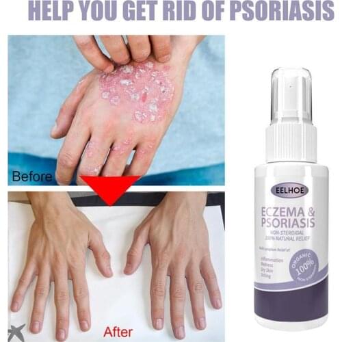 Herbal Eczema Psoriasis Spray Antibacterial Dermatitis Athletes Foot Relieve Itching Irritation Allergies Lithospermum Skin Care