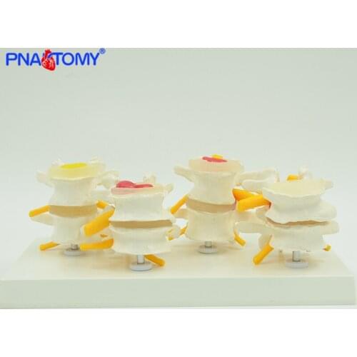 Medical Props Model Human Lumbar Lesion Spine Structure Display Model 1 Set Medical Teaching Learning Tool Life Size Skeleton