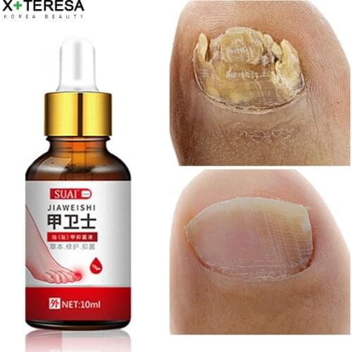 Nail Fungal Treatment Serum Feet Care Essence Nail Foot Fungus Removal Gel Toenails Anti Infection Paronychia Onychomycosis