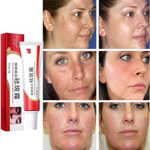 20PCS Effective Whitening Freckle Cream Face Pregnancy Spots Pigmentation Strong Whitening Melasma Clear Melanin Acne Removal