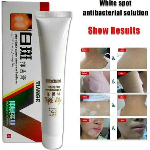 30g Chinese Medical White Spot Disease Cream Pigment Vitiligo Leukoplakia Disease Treatment Melanin Promoting Liniment Skin