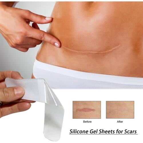Silicone Gel Sheets For Scars Single Sheet Scar Cover Medical Grade Scar Treatment Prevents Keloid Hypertrophic Scarring