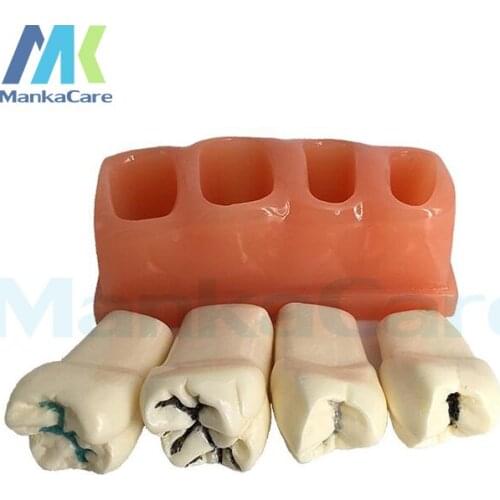 4 Times Caries Disassembling Model Denture Disease Teeth Model For Dentist Clinic 4 tooth model
