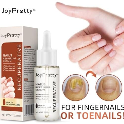 Joypretty Nail Fungus Treatment fungus remedy Essence Serum Removal Gel Anti Infection Paronychia Onychomycosis Care 20ml