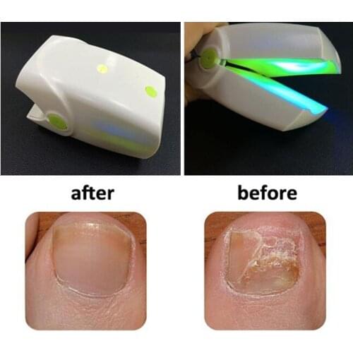 Nail Fungus Light Therapy Treatment Onychomycosis Removal Laser Device Stop Toenail Fungal Infection Device