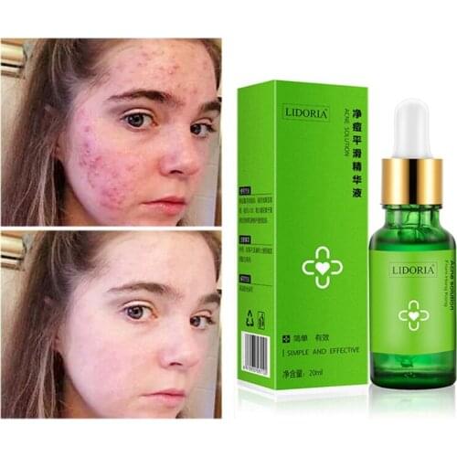 20ML Acne Smoothing Essence Acne Remove Essence Acne Pit Acne Cream Products Stubborn Essential Oil
