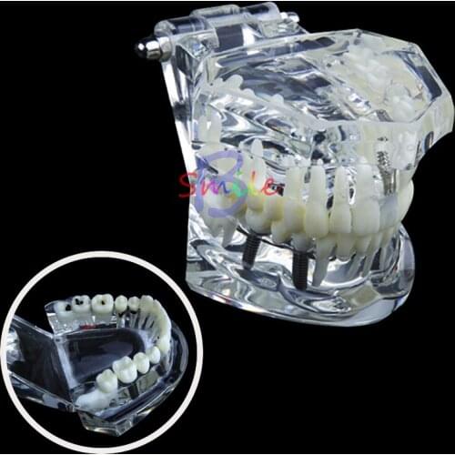 1pcs Promotion Dental Study Tooth Transparent Adult Pathological Teeth Model Dental Lab Equipment Dentist Teaching