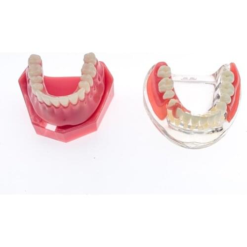 Dental Overdenture Implant Restoration Teeth Model Removable Bridge Denture Demo