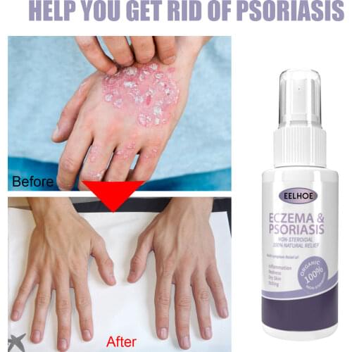Non-Steroidal 100% Natural Extract Relief Eczema &Psoriasis Spray Strong Effective Treatment Psoriasis Dermatitis Eczematoid