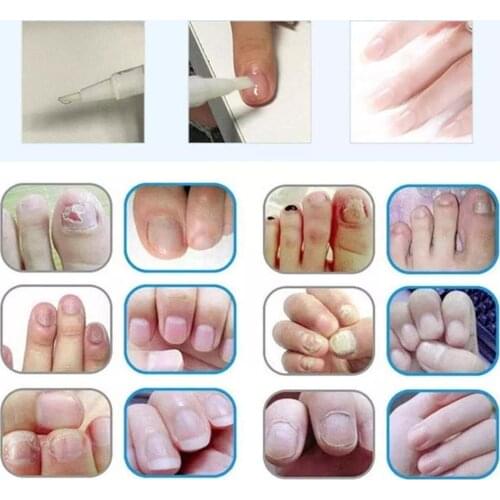 3ml 1Pc Wart Remover Pen Effective Skin Tag Remover Pen Foot Skin Skin Pen Mole Tag Repair Medical Remover Kill Corn K1Z0