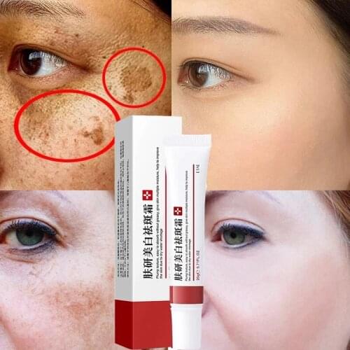 Spots Acne Whitening Cream Remove Dark Spots Facial Gel Repair Fade Freckls Melanin Brighten Skin Care Korea 20g