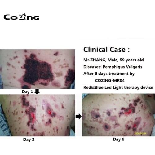 Beauty Product Photon LED Facial Device Therapy Wrinkle Acne And Healing Wound