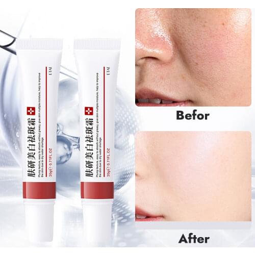 20g Effective Whitening Freckle Cream Remove Dark Spots Anti Freckle Cream Fade Pigmentation Melasma Brighten Creams Skin Care