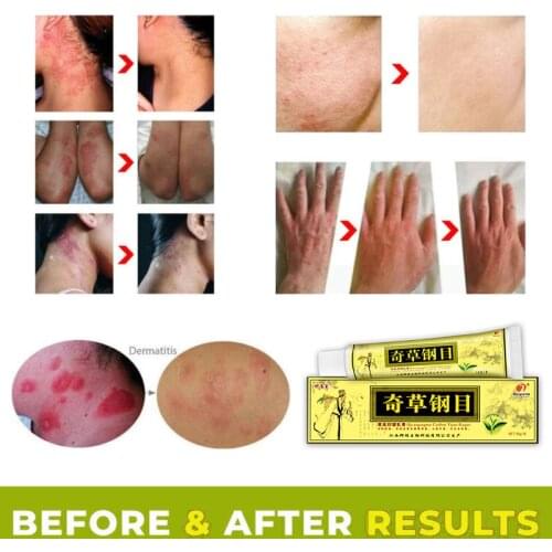Psoriasis Eczma Cream Works Perfect For All Kinds Of Skin Problems Body Dermatitis Treatments Chinese Medicine Ointment TSLM1
