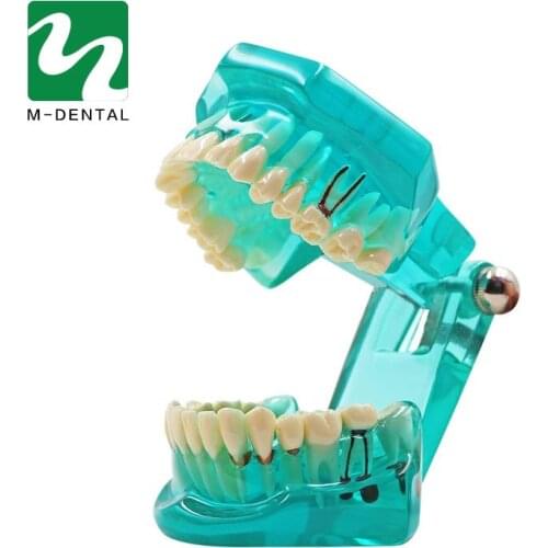 Dental Teeth Model Implant Model Transparent Blue Removable Teeth Model Teaching Teeth Tool Dental Adult For Medical Science