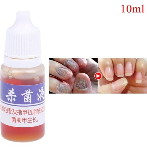 1Pc Fungal Nail Treatment Feet Care Essence Foot Whitening Toenail Fungus Removal Anti Infection Paronychia Onychomycosis Useful