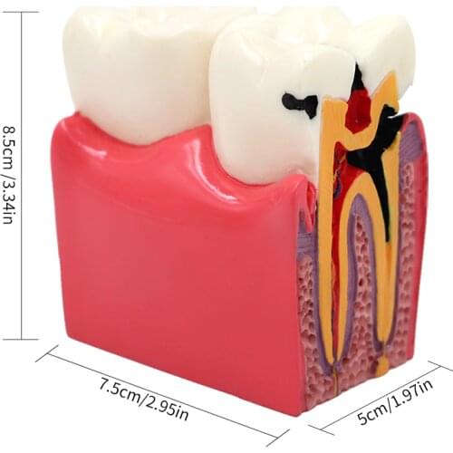 6 Times Caries Dental Comparsion Model For Dental Study Teaching and Researching as Anatomy Education Teeth Model