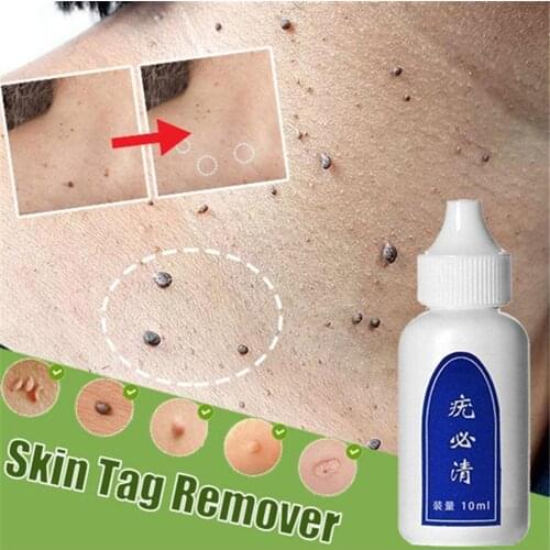 10ml No Trace Wart Liquid To Remove Warts And Flat Warts Skin Repair No Trace Beauty Liquid To Remove Skin Tags