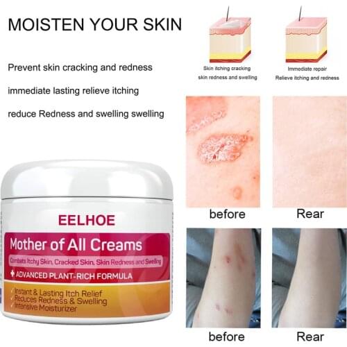 20/30/50g Psoriasis Eczma Cream Dermatitis Eczematoid Eczema Ointment Treatment Psoriasis Cream Skin Care Cream Effective