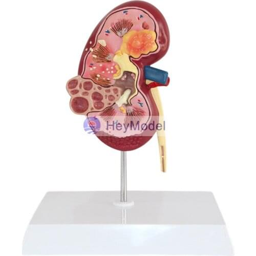 HeyModel Kidney Lesions Model