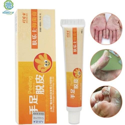 KONGDY Prevent Hand&Foot Molt Cream Anti-Hand Foot Fungal Infection Ointment Removal Skin Horny Chinese Herbal Medicine Care
