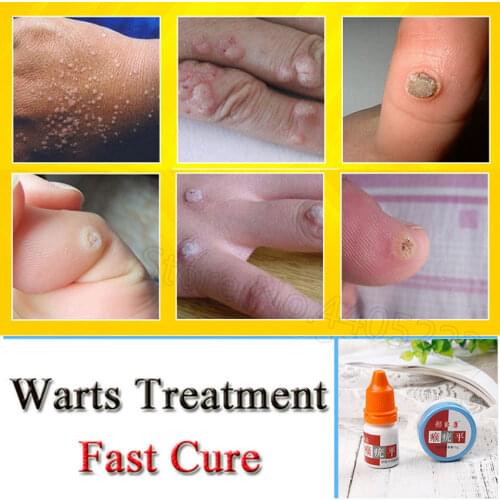 Foot Corn Removal Cream Foot Care Medical Plaster Calluses Plantar Warts Thorn Plaster Chicken Eye Ointment Relieving Pain Patch