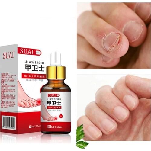 SUAI 10ML Fungal Nail Repair Essence Serum Treatment Care Foot Nail Fungus Removal Gel Anti Infection Paronychia Onychomycosis
