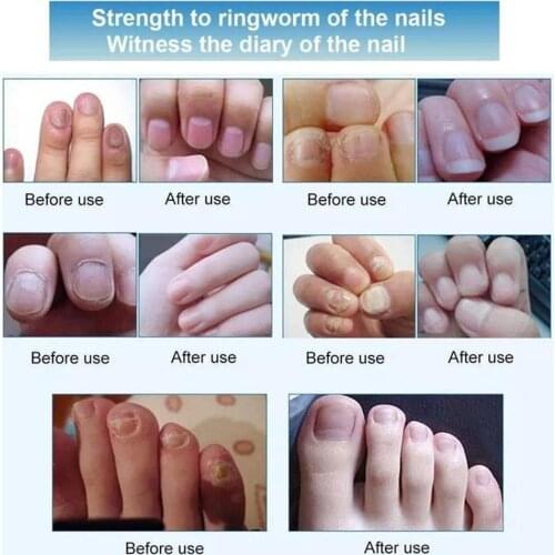 1pc Effective Skin Repair Pen Medical Kill Remover Corn Foot Skin Tag Liquid Mole & Care Genital Remover Wart Health T7P7