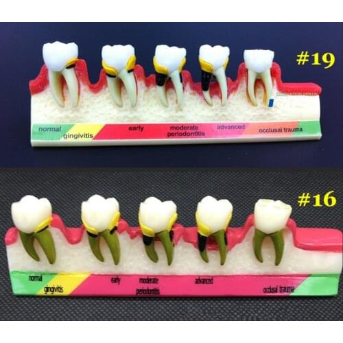 1Pc Dental Teeth Model for Periodontal pathological Diseases Assorting & Pathology Tooth Classification
